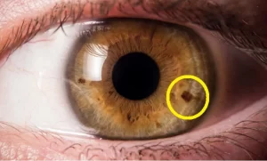 Spiritual Meaning of Black Dot In Iris