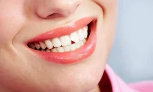 Spiritual Meaning of chipped tooth